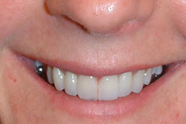 Crown & Bridges After