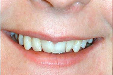 Crown & Bridges Before