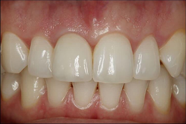 Implants After