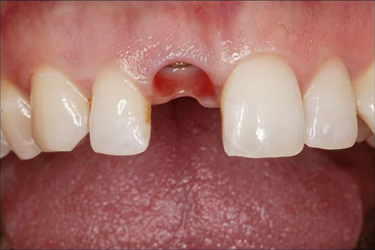 Implants Before