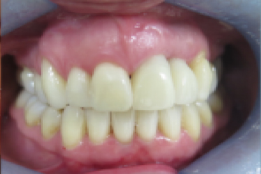 Invisalign After