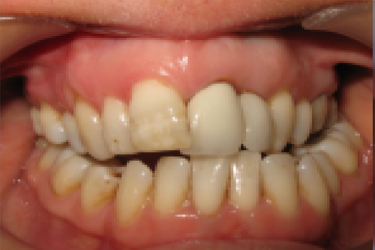Invisalign Before