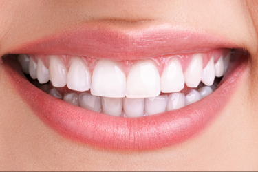 Teeth Whitening After