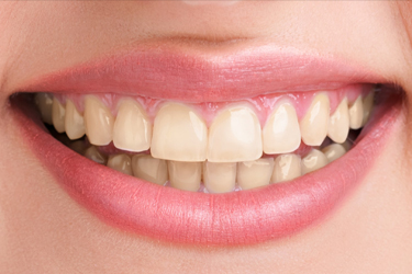 Teeth Whitening Before