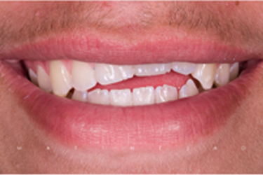 Veneers Before